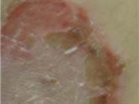 î÷àã ñòðåïòîäåðìèè