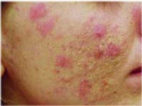 ñòðåïòîäåðìèÿ íà ëèöå